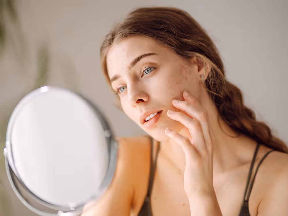 Uma jovem mulher de pele clara e olhos azuis, com acne visível no rosto, olha atentamente para um espelho redondo. Ela toca suavemente a bochecha com os dedos, com uma expressão preocupada, enquanto examina sua pele. Seu cabelo castanho está preso em uma trança lateral