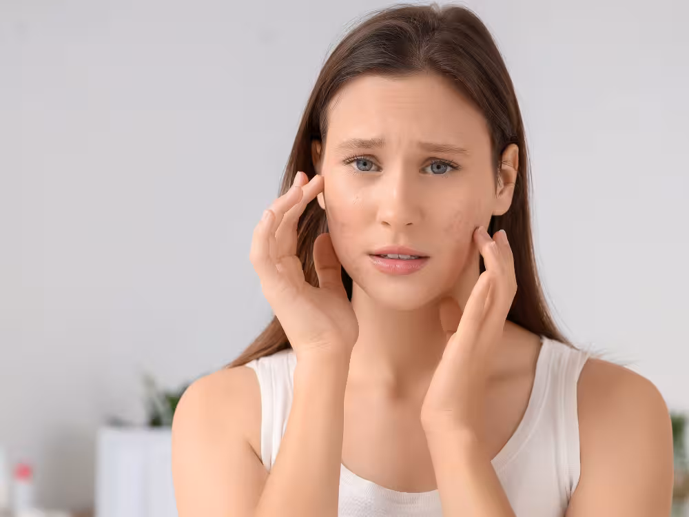 Uma jovem mulher com cabelo castanho longo e olhos azuis olha diretamente para a câmera com expressão preocupada e sobrancelhas franzidas. Ela tem acne visível nas bochechas e queixo, e toca o rosto com as duas mãos, com os dedos suavemente apoiados na pele. Usa uma regata branca.